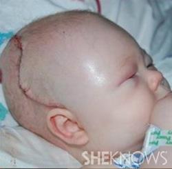 ทารกที่มี craniosynostosis