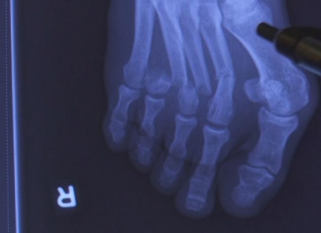 En röntgenbild av en Save My Life-skada.