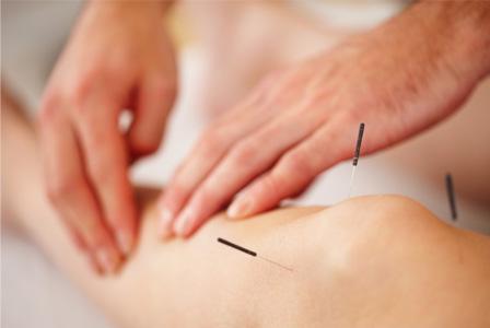 Nő akupunktúrát kap