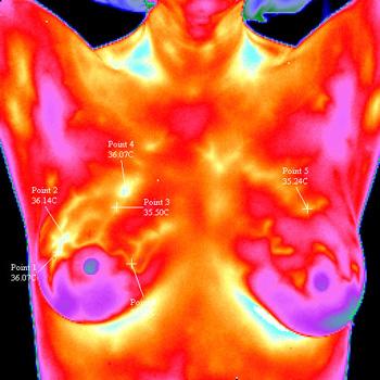 Brustthermografie